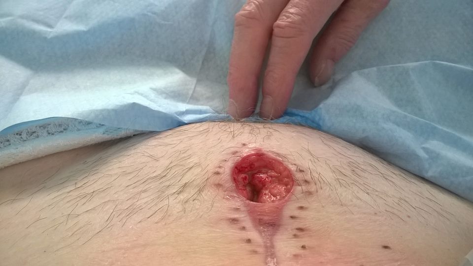 RECTAL STUMP BLOWOUT – TOMAS THE STOMA