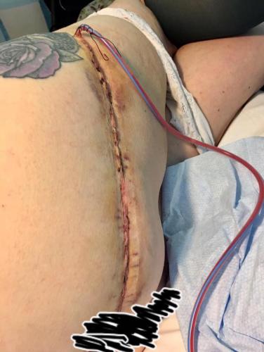IGAM flap straight out of surgery
